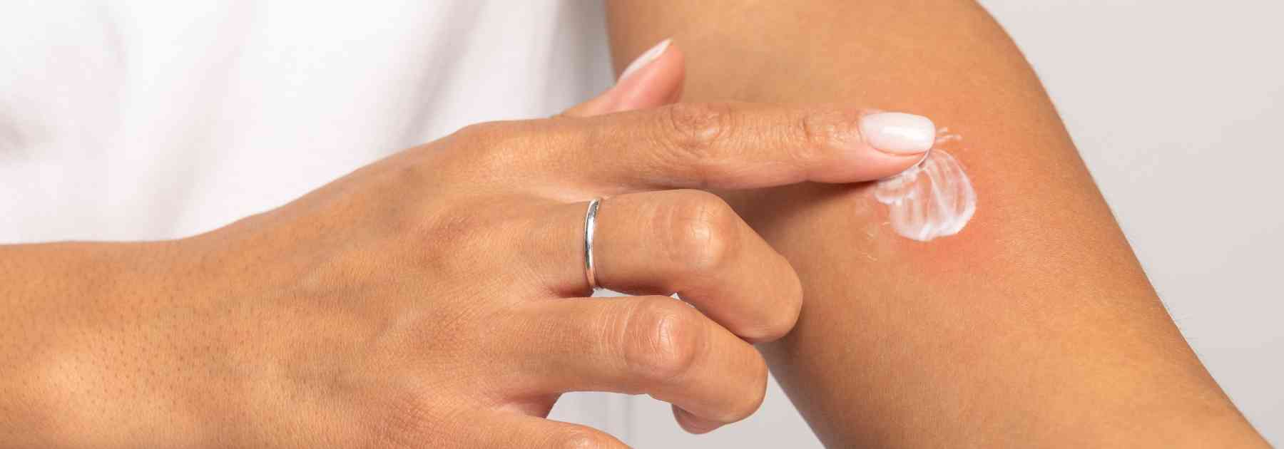 infected insect bite treatment