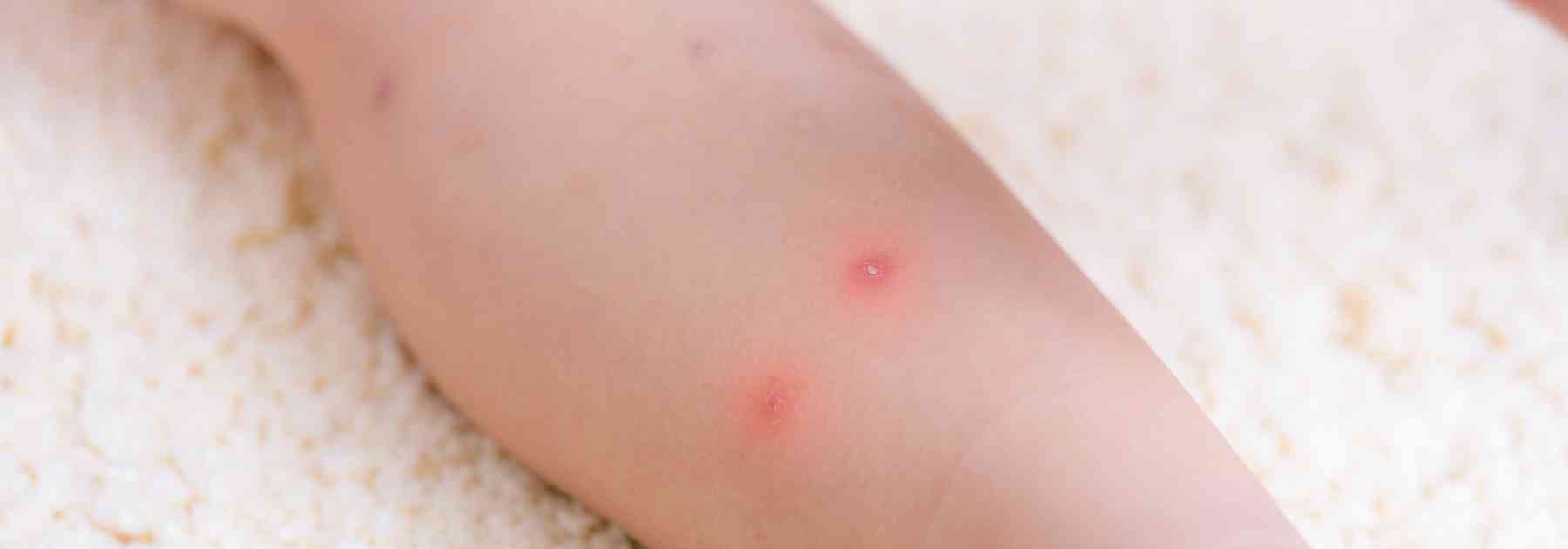 how to treat an infected insect bite