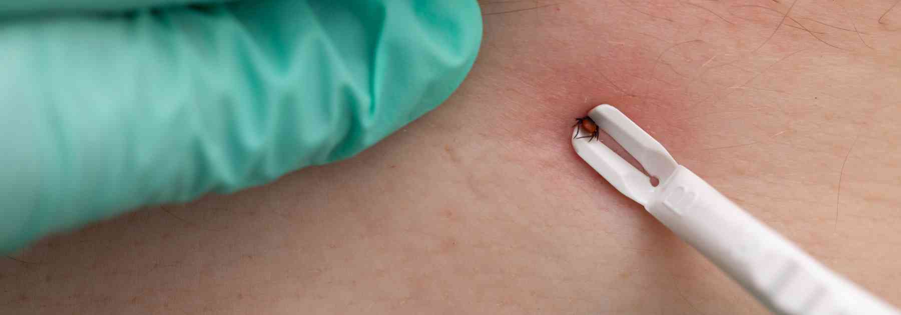 how to use a tick remover tool