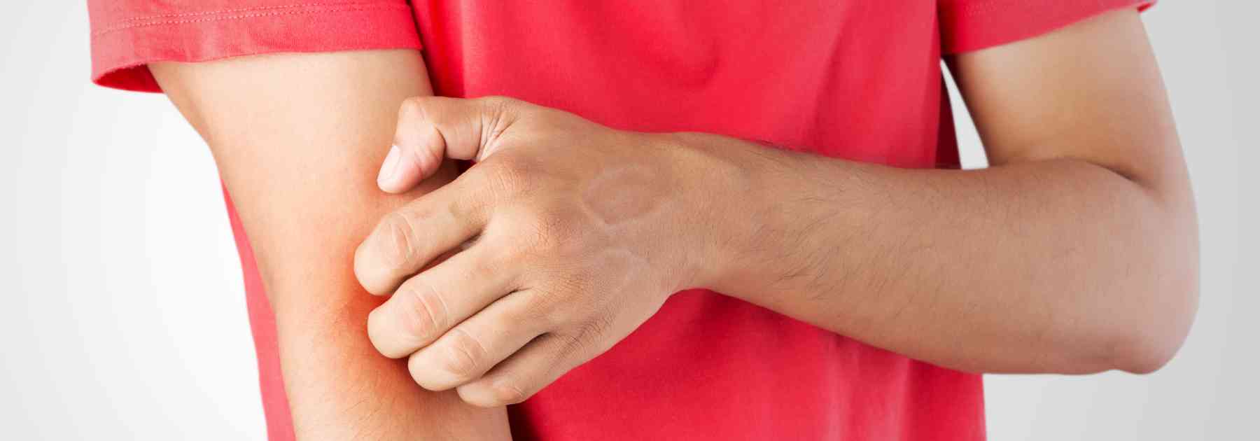 what does dengue fever rash look like